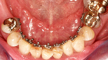 Zahnfehlstellung korrigieren